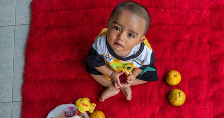 covid-19-worsens-‘double-burden’-of-child-malnutrition-in-indonesia